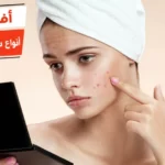 أفضل 10 أنواع سيروم لعلاج حب الشباب