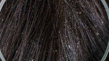 التخلص من قشرة الشعر