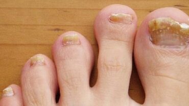 علاج فطريات الأظافر
