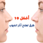 أفضل 10 طرق لعلاج آثار الحبوب