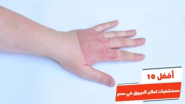 أفضل 10 مستشفيات لعلاج الحروق في مصر