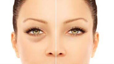 للحد من الانتفاخات أسفل العين