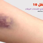 أفضل 10 أنواع مرهم لعلاج الكدمات الزرقاء