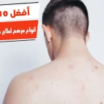 أفضل 10 أنواع مرهم لعلاج حبوب الظهر والصدر