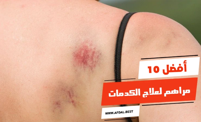 أفضل 10 مراهم لعلاج الكدمات