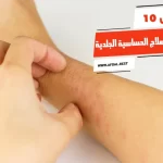 أفضل 10 مشروبات لعلاج الحساسية الجلدية