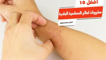 أفضل 10 مشروبات لعلاج الحساسية الجلدية