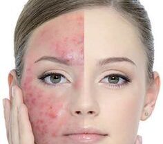 محلول أكني بيوتك- Acne Biotic