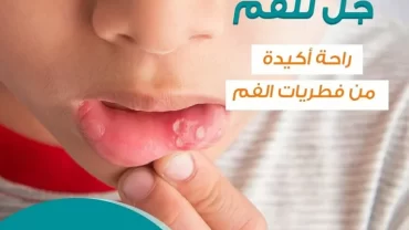 ميكوناز جل  Miconaz  2% Oral Gel